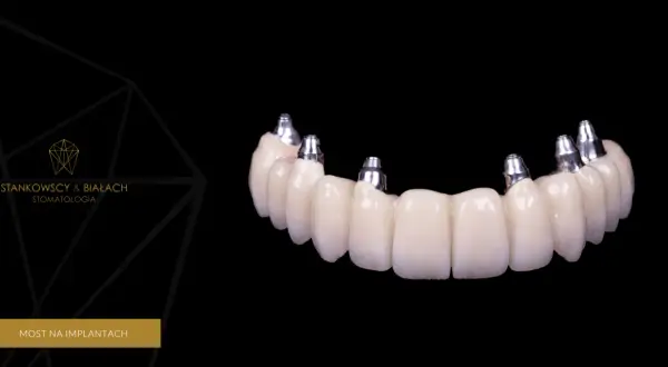 Wstawienie zęba: Implant, most, proteza? Poznaj koszty i wybierz!