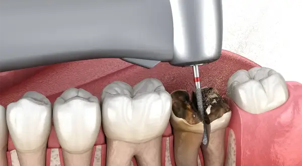 Ekstrakcja zęba z ropniem: Czy to możliwe? Kiedy dentysta usunie ząb?