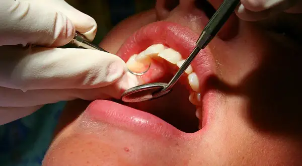 Dentysta wykonuje leczenie kanałowe zęba, używając lusterka i narzędzi.