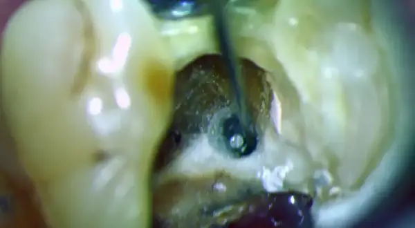 Ząb z odsłoniętą miazgą, gdzie narzędzie dentystyczne pracuje w kanale korzeniowym.