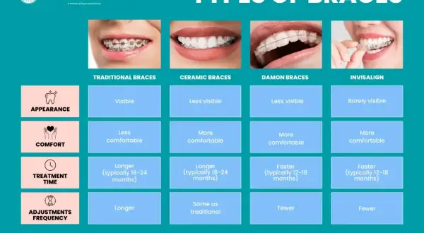 Porównanie aparatów na zęby ludzkie: tradycyjny, ceramiczny, Damon i Invisalign. Różnice w wyglądzie, komforcie, czasie leczenia i częstotliwości wizyt.