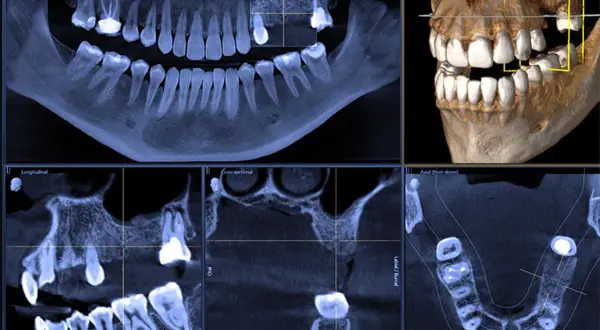 CBCT co to? Wielopłaszczyznowe badanie zębów i szczęki, pokazujące szczegółowo strukturę kostną i uzębienie.
