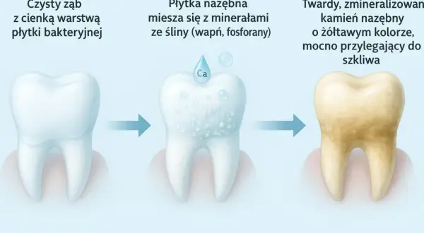 Ilustracja pokazuje, skąd się bierze kamień na zębach: płytka bakteryjna miesza się z minerałami ze śliny, tworząc twardy, żółtawy kamień nazębny.