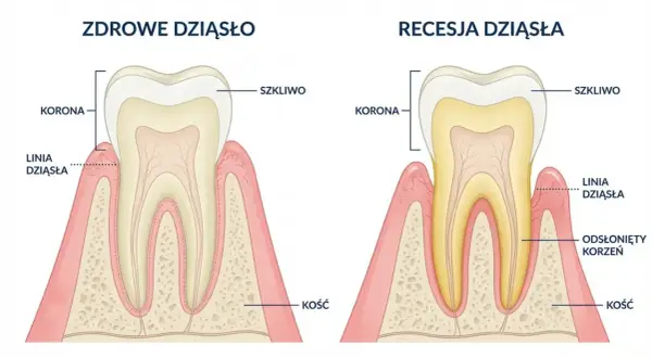 Porównanie zdrowego dziąsła z recesją, gdzie widać odsłonięty korzeń zęba. Próchnica przy dziąśle postępuje.