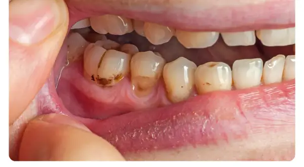 Domowe sposoby na próchnicę: Co naprawdę działa, zanim pójdziesz do dentysty?