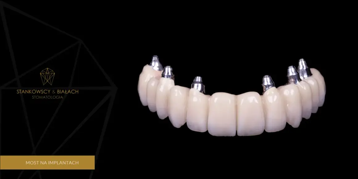 Wstawienie zęba: Implant, most, proteza? Poznaj koszty i wybierz!