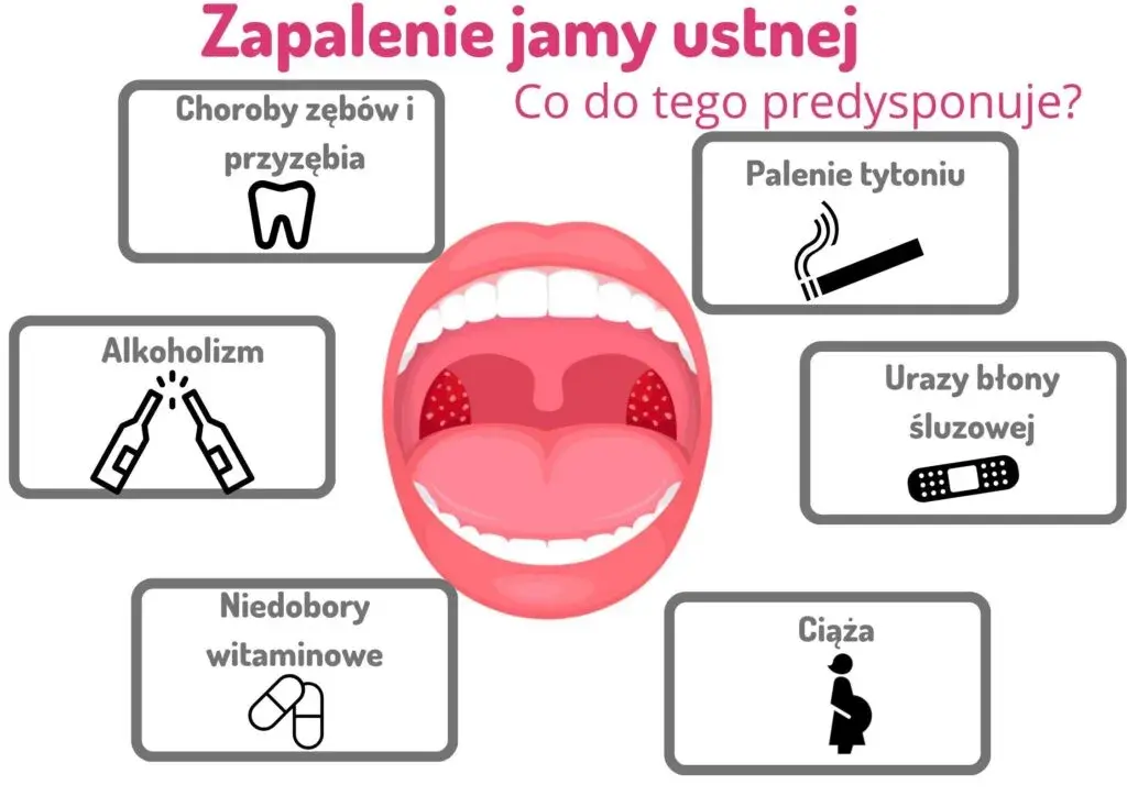 Jak szybko złagodzić zapalenie w jamie ustnej? Domowe i apteczne metody