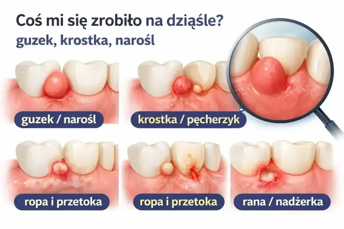 Ilustracja pokazuje zmiany na dziąśle: guzek, krostkę, ropę i przetokę. W przypadku ropy i przetoki, jaki antybiotyk na ząb z ropą jest najlepszy?