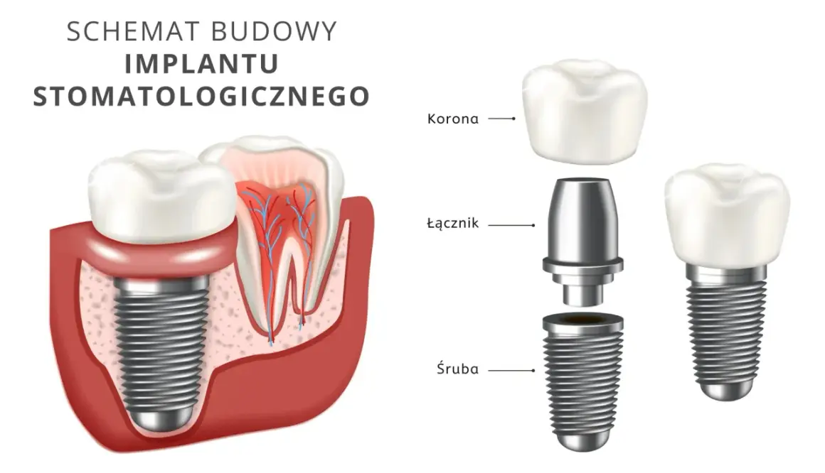 Ile kosztuje implant zęba? Pełny przewodnik po cenach i kosztach
