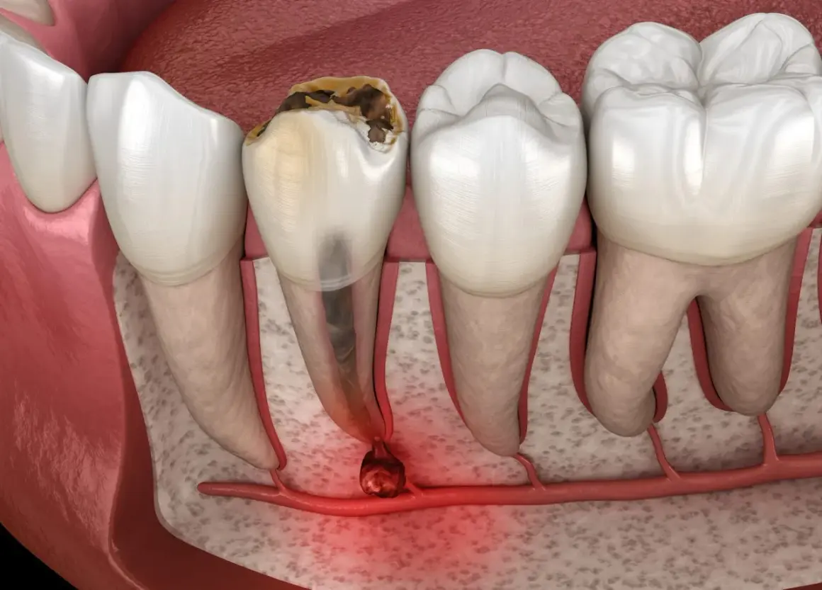 Zepsuty ząb z zapaleniem wierzchołka korzenia. To pokazuje, czym jest endodoncja – leczenie kanałowe.