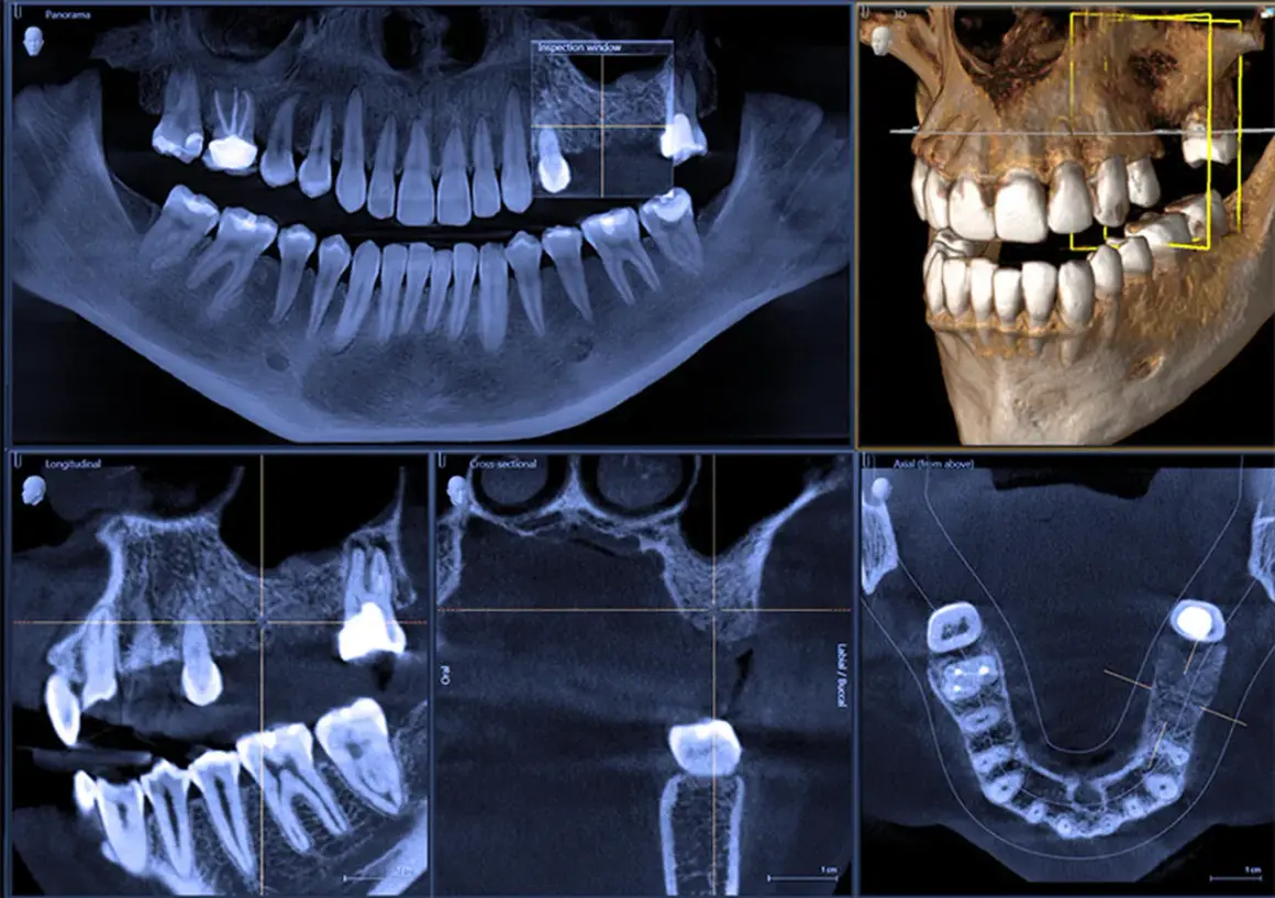 CBCT co to? Wielopłaszczyznowe badanie zębów i szczęki, pokazujące szczegółowo strukturę kostną i uzębienie.