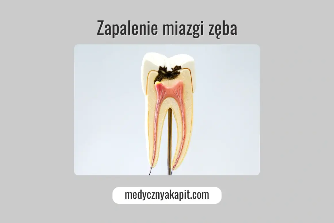 Model zęba z próchnicą i widoczną miazgą. Zapalenie miazgi zęba jak uśmierzyć ból.