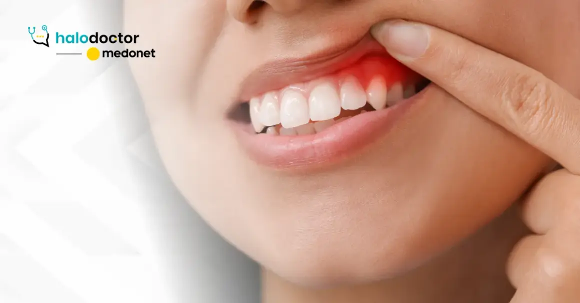 Stan zapalny dziąseł: Jak skutecznie leczyć w domu i u dentysty?