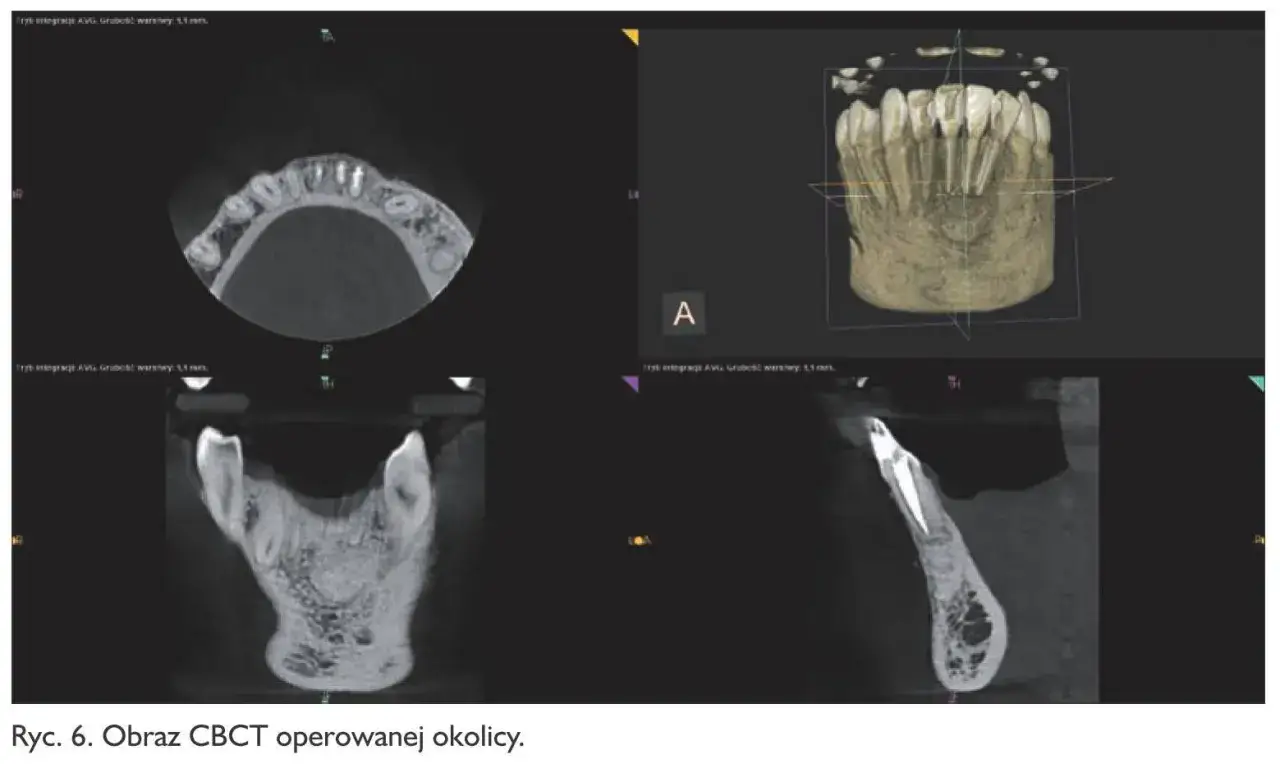 Obraz CBCT pokazuje zmiany okołowierzchołkowe, które mogą być objawami ziarniniaka zęba. Widoczne są przekroje zębów i kości szczęki.