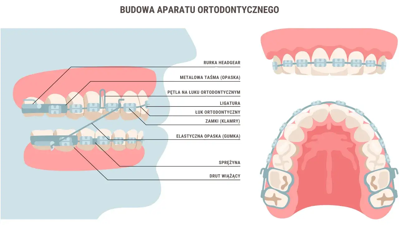 schemat działania aparatu ortodontycznego przebudowa kości