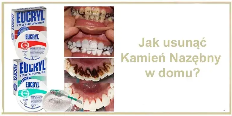 domowe sposoby usuwania kamienia nazębnego