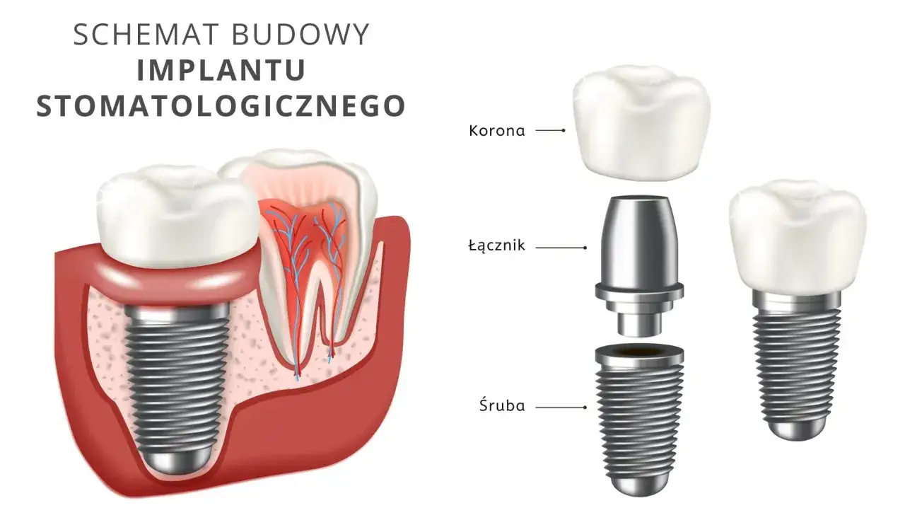implant zęba schemat budowy