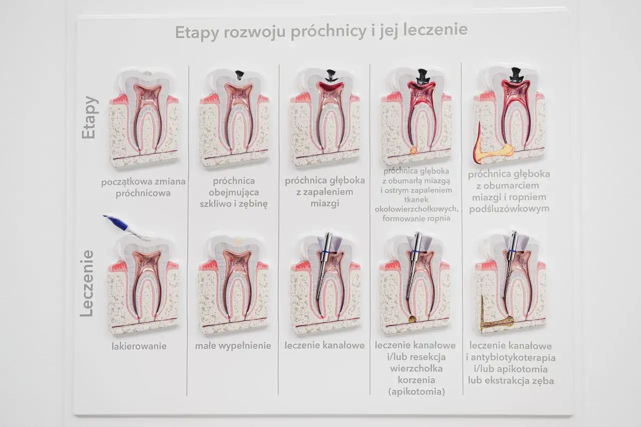 Schemat przedstawia etapy rozwoju próchnicy i jej leczenia. Widoczna jest dziura w zębie, która pogłębia się wraz z postępem choroby.