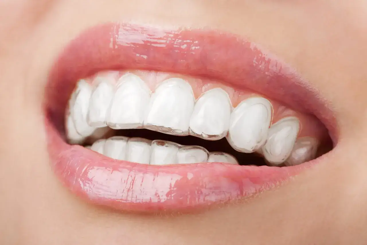 przezroczyste nakładki Invisalign na zębach i poza jamą ustną