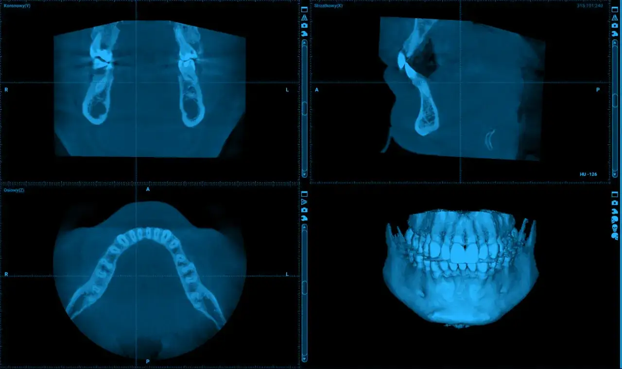 zdjęcie rentgenowskie zęba, tomografia cbct zęba