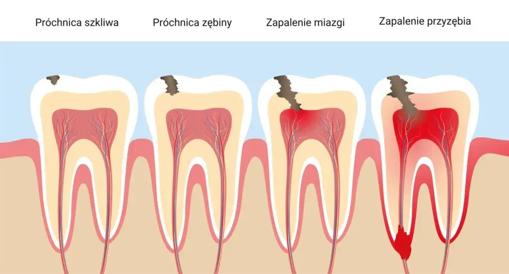 Rodzaje bólu zęba infografika
