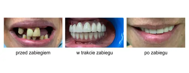 implanty całej szczęki przed i po