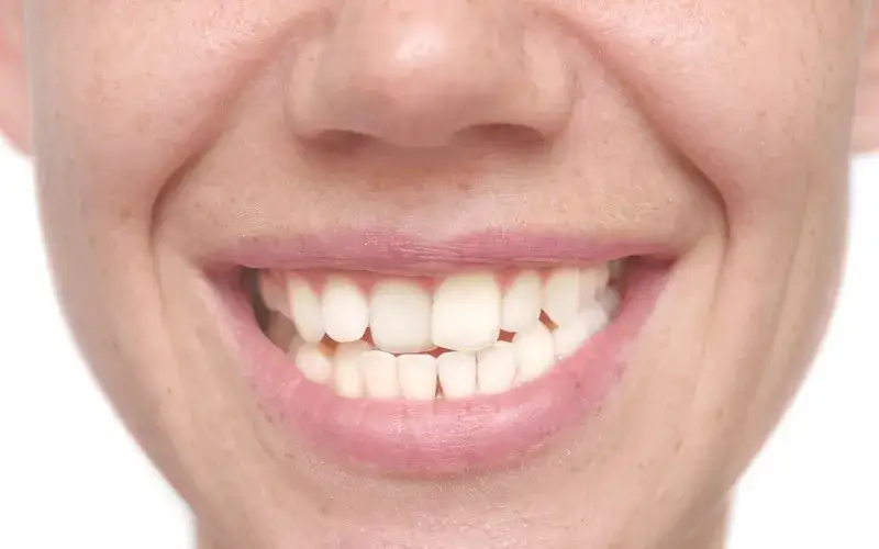 widoczne wady zgryzu stłoczenia diastema