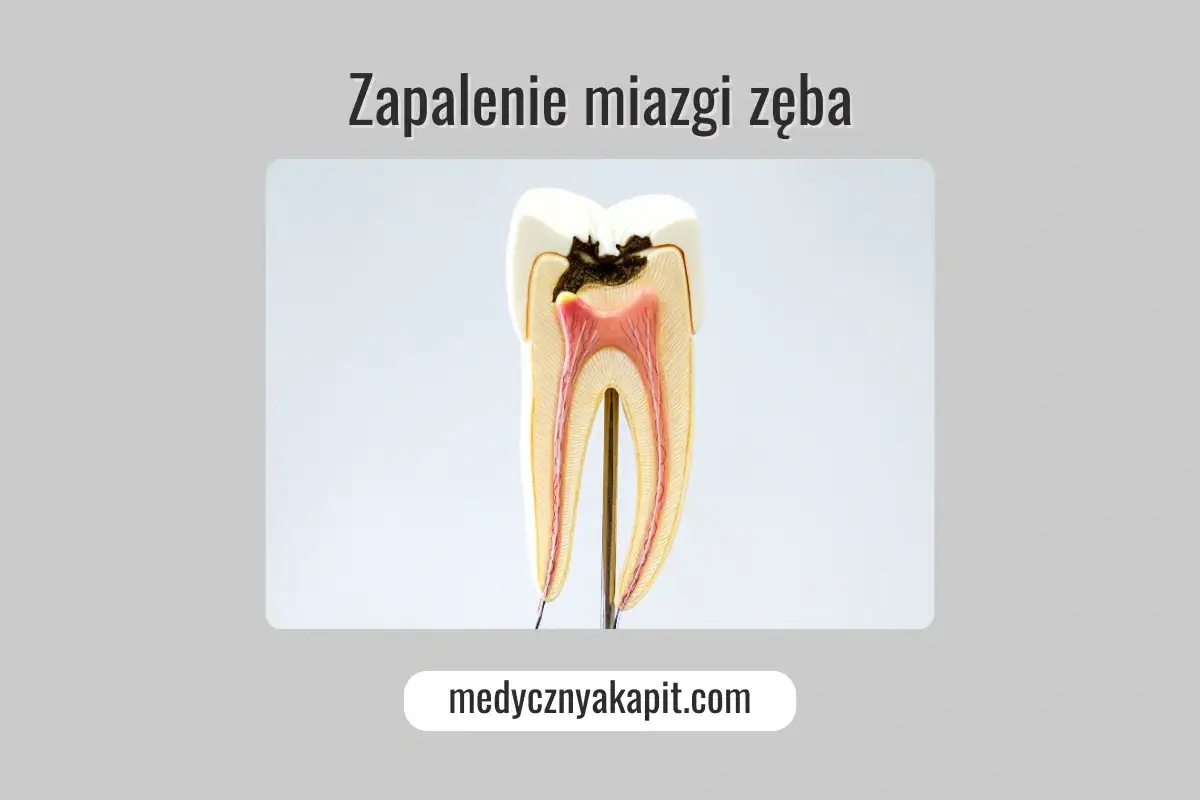Model zęba z widoczną próchnicą i odsłoniętą miazgą zęba, wskazującą na zapalenie.