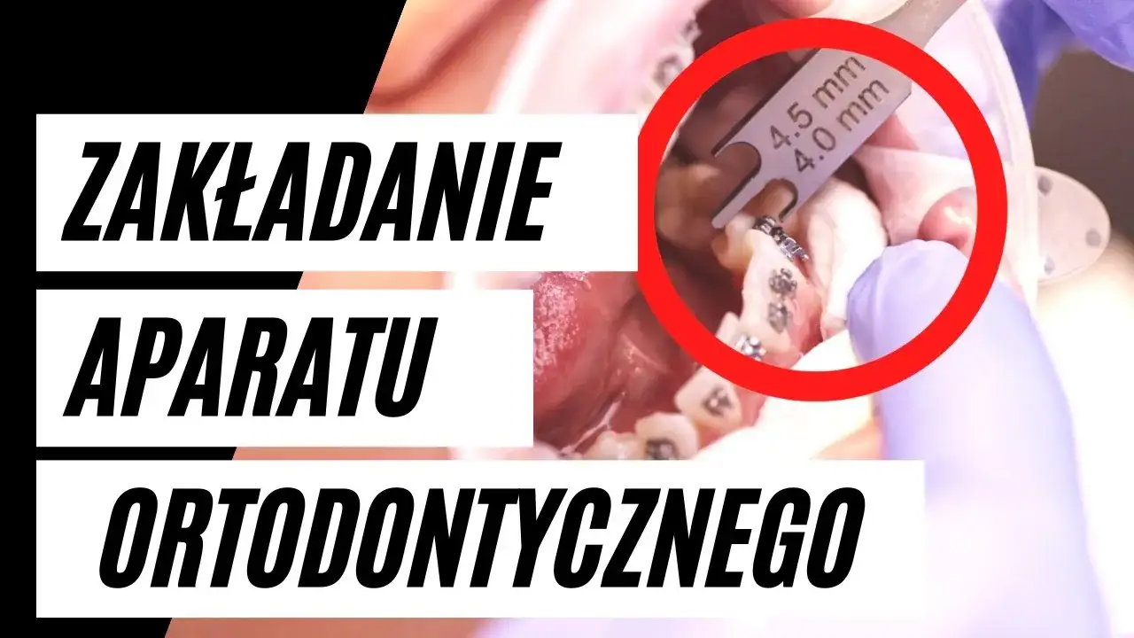 proces zakładania aparatu ortodontycznego krok po kroku