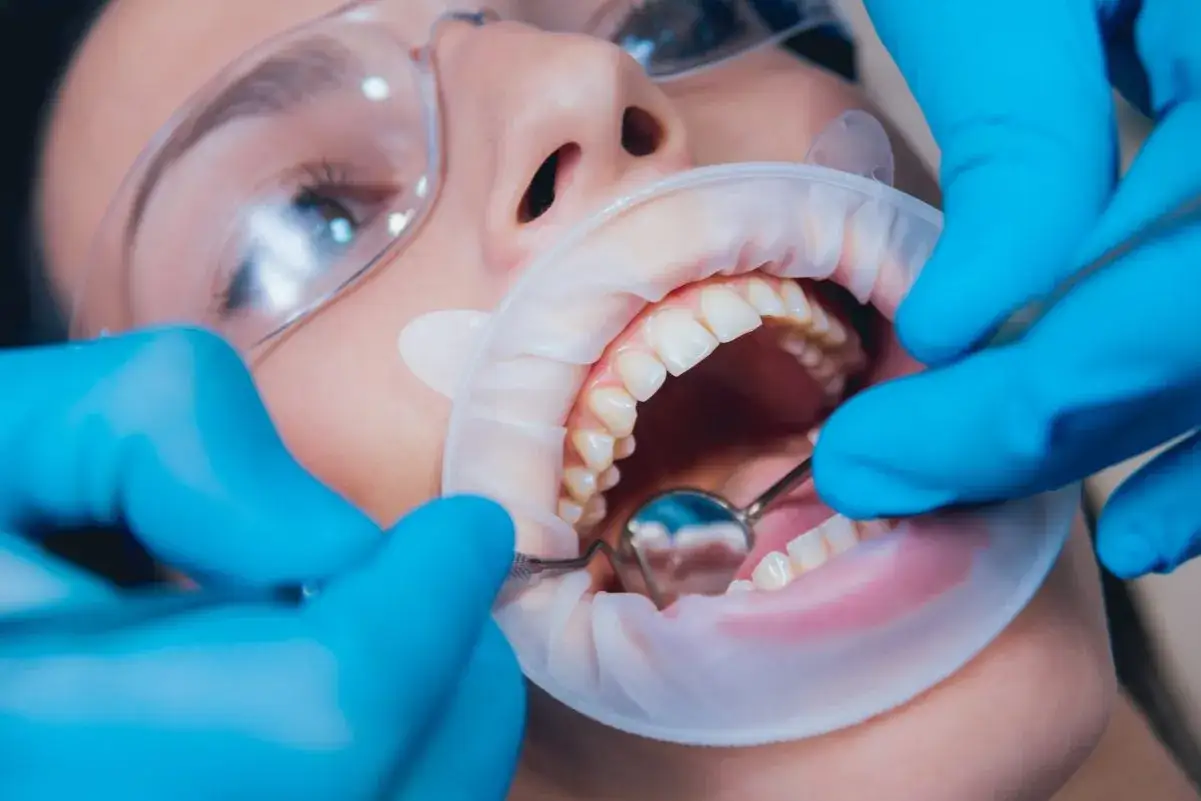 Dentysta bada zęby pacjenta. Widoczne są narzędzia stomatologiczne i rozwierak. To może być początek leczenia kanałowego, czyli endodoncja co to jest, gdy ząb boli.