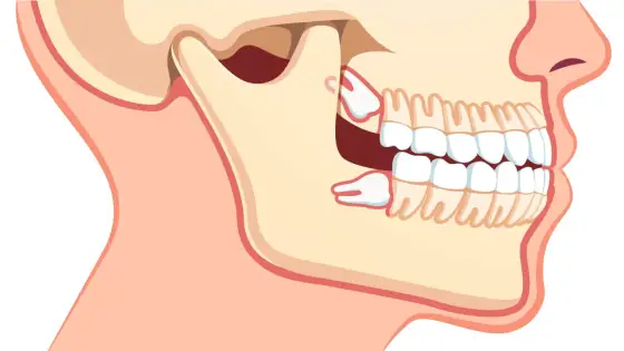 Przeciążony ząb - objawy, przyczyny i leczenie u dentysty