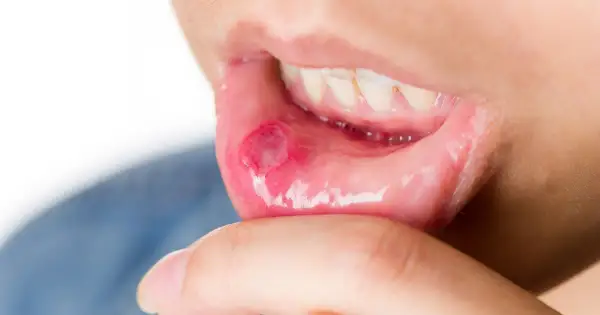 Afta w ustach a dentysta: Czy wizyta jest możliwa? Decyzja krok po kroku
