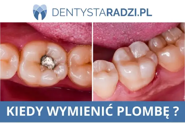 Porównanie zęba z plombą i bez. Widoczny mały ubytek w zębie po lewej, po prawej zdrowy ząb.