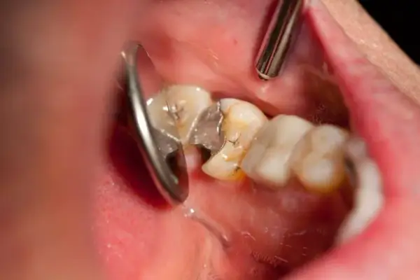 Zęby psują się od środka? Choroby ogólnoustrojowe, które je niszczą