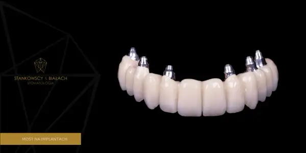 Wstawienie zęba: Implant, most, proteza? Poznaj koszty i wybierz!