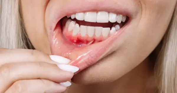 Widoczne zaczerwienienie i biała kropka na dziąśle wskazują na stan zapalny zęba.