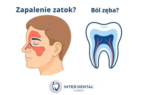 Zapalenie zatok czy ból zęba? Ilustracja porównuje objawy zapalenia zatok z budową zęba, sugerując, że ból zębów może być mylony z innymi dolegliwościami.