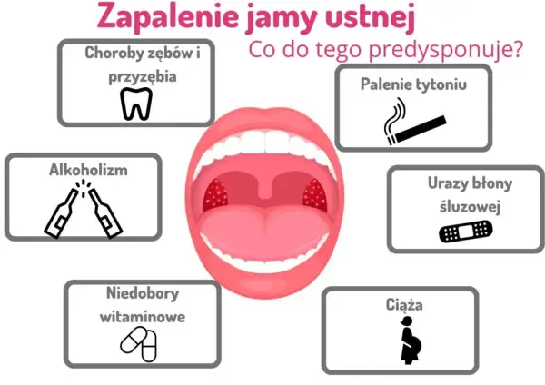 Jak szybko złagodzić zapalenie w jamie ustnej? Domowe i apteczne metody
