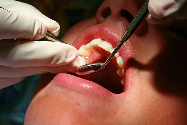 Dentysta wykonuje leczenie kanałowe zęba, używając lusterka i narzędzi.