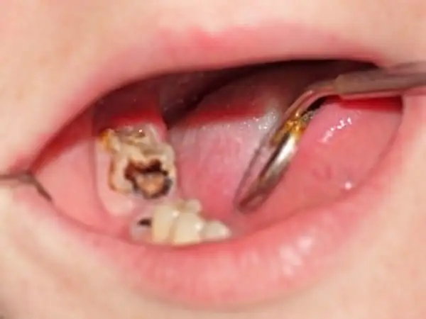 Widoczna duża dziura w zębie, z próchnicą i resztkami jedzenia. Dentysta bada ząb.
