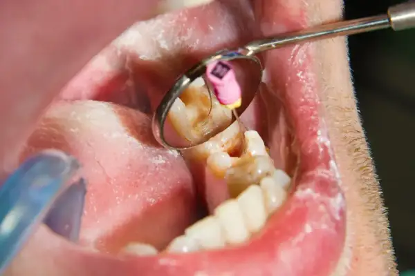 Widok jamy ustnej z lusterkiem dentystycznym. W odbiciu widać ząb z narzędziem, sugerującym leczenie ropnia zęba.
