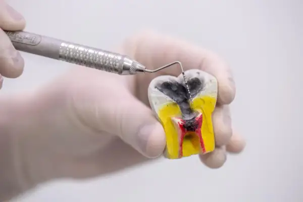 Model zęba z widoczną próchnicą zaawansowaną, gdzie narzędzie dentystyczne bada zniszczone tkanki.